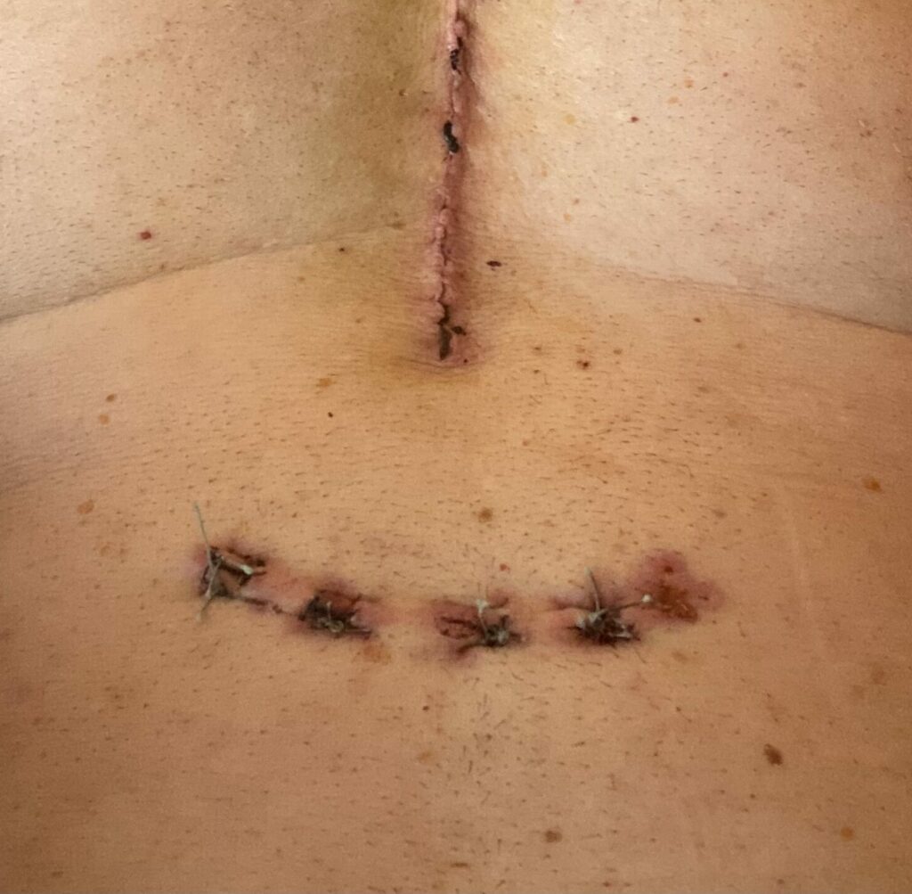 Operationsnarben an Bauch und Brust